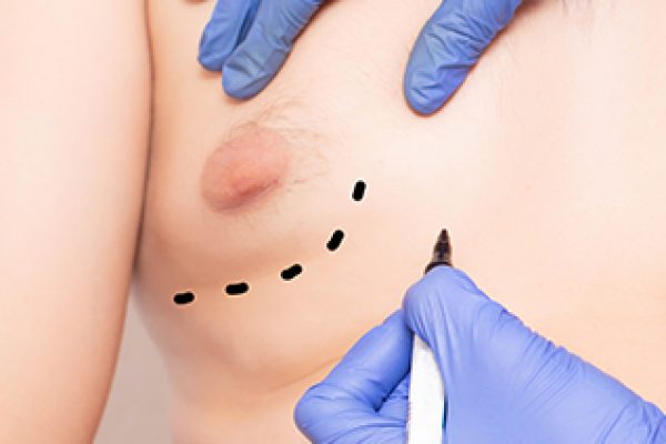 Plastic surgeon preparation, marking the breast of a man