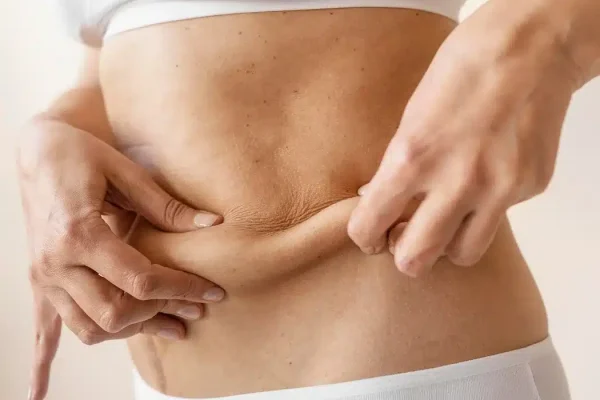 Loose abdominal skin after significant weight loss before considering a tummy tuck at Ditesheim Cosmetic Surgery in Charlotte NC