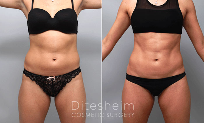 The image showcases the successful combination of arm liposuction with other procedures. Vaser Liposuction, utilizing the High Definition Liposculpting technique, was employed to sculpt the abdomen, hips, waist, and arms. This approach selectively removed fatty tissue to accentuate the definition of underlying muscles and improve the shape of the buttocks. The photo highlights the outcomes of these procedures, illustrating how they can effectively work together to achieve desired results.
