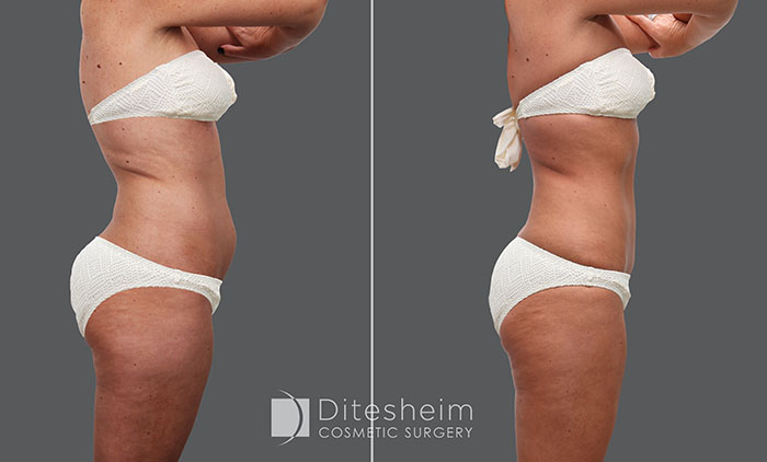 Woman's body before and after Liposuction abdomen and thighs.