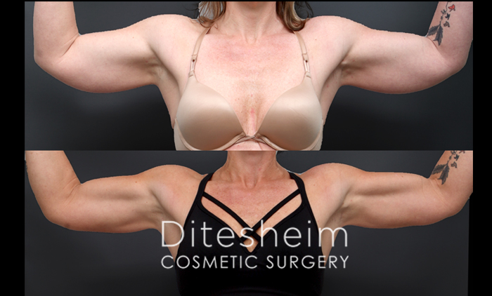 Athletic woman's arms before and after liposuction to create more definition of muscles, front view