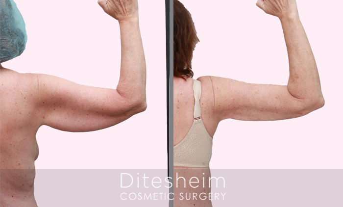 The picture shown demonstrates the results of a Brachioplasty (Arm lift) procedure performed after significant weight loss. The patient is a 46-year-old woman who had a higher weight of 252lb but has now stabilized at 165lb. She sought to enhance the appearance of her arms after losing a considerable amount of weight. The procedure involved the removal of excess stretched skin and some remaining fatty tissue. Achieving improved arm shape following substantial weight loss is accomplished through an arm lift or Brachioplasty, where skin and fat are addressed in a single operation.