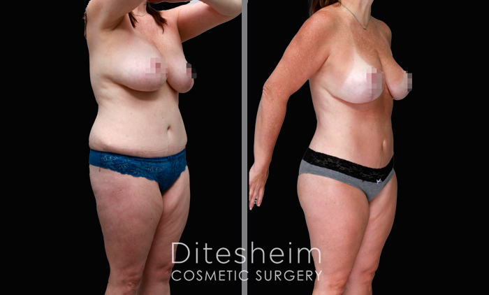 50yr woman 5’7” 178lb before and after Lipo360 and fat grafting. She treated her tummy,waist, arms, inner thighs and back. Her breast implants were removed and fat grafts used to augmentthe breasts and buttocks.