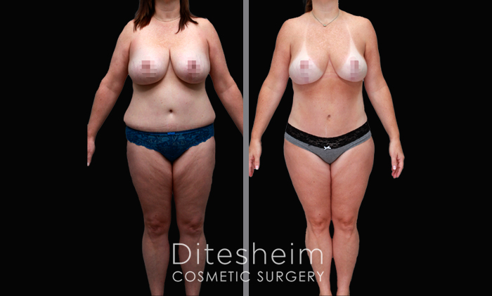 Twelve years after a Mommy Makeover, this 50 year old woman lost the shape she once had. Herbreasts were reshaped by removing her implants and fat grafting the breasts. Her waist and tummywere defined with Vaser Lipo360, treating the body circumferential. Before and After 6 months herweight is the same.