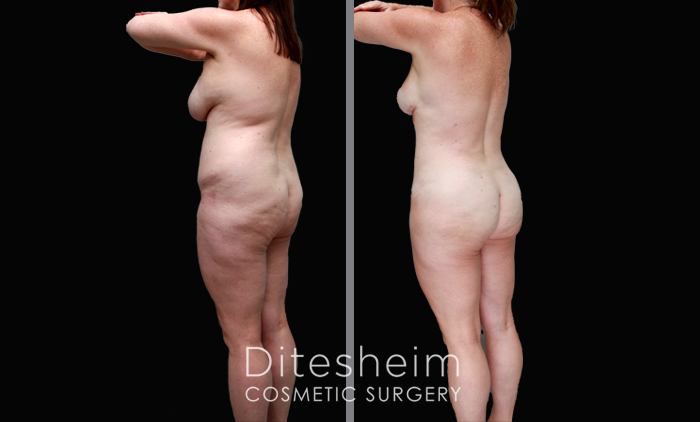 4D (4 dimensional body sculpting) is the combination of artistic circumferential liposuction (LIPO360)and fat grafting. With a narrow pelvis and fatty tissue excess in the torso her body was not proportional.By adding fat to the buttocks and hips and reducing the waist and back, the buttocks has a smoother, rounder more feminine shape giving her better proportion from waist to hips. Note that comparing before to after 6 months, her weight is the same but her waist decreased 4”.