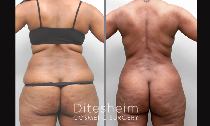 56yr woman who had liposuction back and circumferential thighs, knees and legs w Renuvion