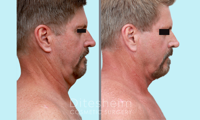 Before and after Renuvion on the right side of a male's head and neck.