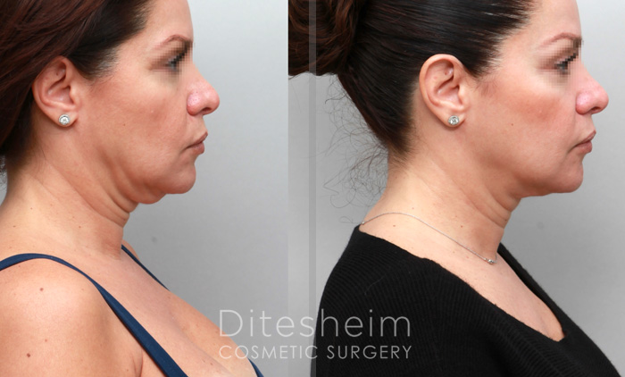 Before and after neck liposuction images of a woman's head and neck, taken from the right side.