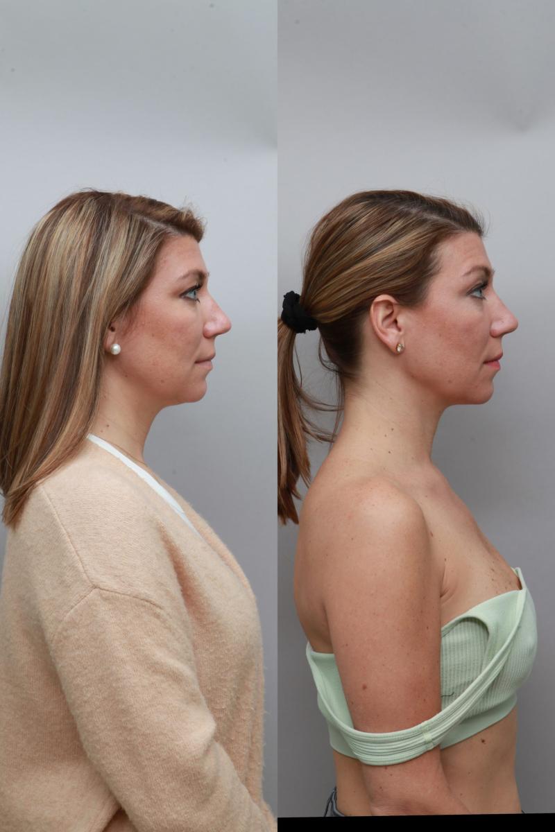 Before and after images showcasing the results of Renuvion Neck on the right profile of a 41-year-old female.