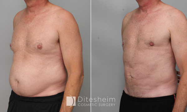 Liposuction of the abdomen in two stages, skin contracted to give a flatter tummy.  Both procedures were done with the patient awake with local anesthesia. 