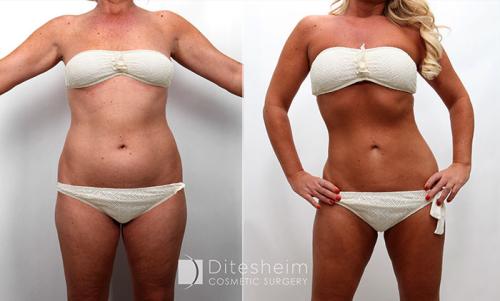 Frontal view of a woman's physique pre- and post-liposuction on the abdomen and thighs.