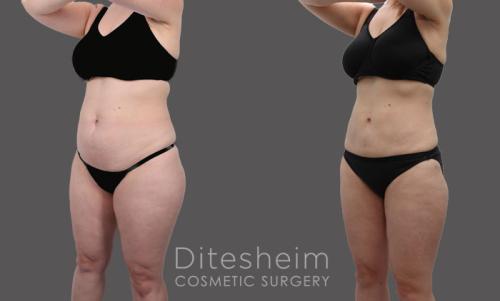 Comparison of a woman's physique pre- and post-abdominal and thigh liposuction using the Hi-definition technique, from a leftward perspective.