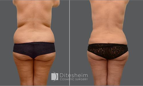 Posterior View of a Woman's Body Before and After Abdomen Liposuction