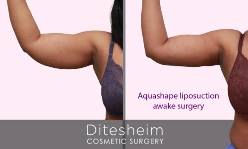Female arms treated with aquashape liposuction front view before and after copy