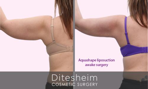 Female arms treated with aquashape liposuction rear view (SK) before and after copy