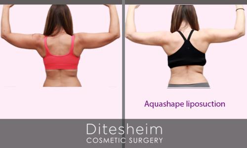 Female arms treated with aquashape liposuction rear view before and after copy