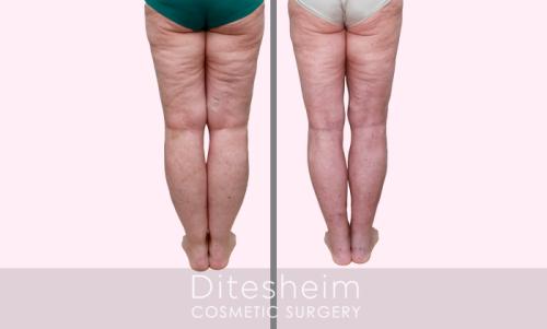 Lipedema Stage 2 DJ legs front view before and 2 months after liposuction treatment copy