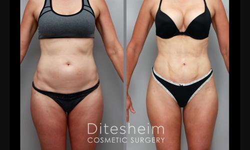 VaserLipo and Renuvion for inner thigh shaping and “thigh gap” This patient had torso lipo ( abdomen and back and inner thighs w Renuvion). 