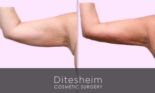 The image displays the results of arm liposculpting. A 46-year-old woman, who had previously undergone breast and tummy surgery, decided to refine the appearance of her arms using Aquashape Water-assisted liposuction. This innovative technique involves selectively removing fat, often without general anesthesia. The photo demonstrates how the woman achieved her desired arm definition through this precise and less invasive approach.