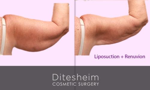 Liposuction arms with Renuvion rear view before and after copy