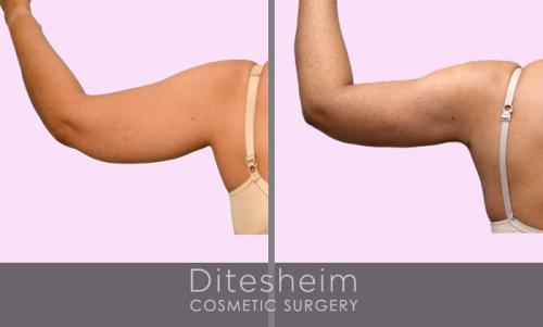 Liposuction awake arms (WL) rear view before and after copy