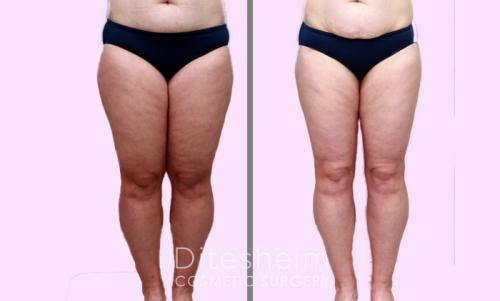 Liposuction circumferential thighs front view