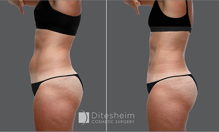 Woman's body before and after Liposuction in abdomen with water Liposuction, left profile