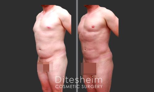Male High Definition Liposuction BJ oblique2 copy