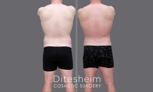 Male High Definition Liposuction rear view shoing back shaping BJ copy
