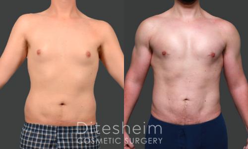 Male_chest_High Definition Liposuction w fat grfting_BC