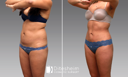Woman's body before and after high definition liposuction in abdomen, left angle