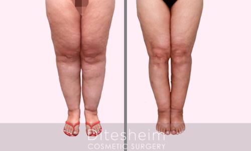 Stage 3 Lipedema DO after Water liposuction treatment knees,legs, distal thighs, ankles copy
