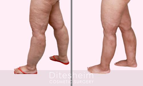 Stage 3 Lipedema DO after Water liposuction treatment knees,legs, distal thighs, ankles profile view copy