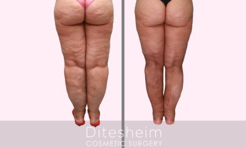 Stage 3 Lipedema DO after Water liposuction treatment knees,legs, distal thighs, ankles rear view copy
