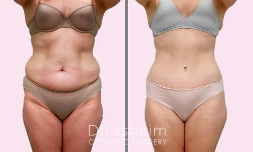 Tummy tuck with hip liposuction before and after front view copy
