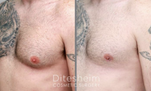 Awake liposuction: Athletic young male had awake liposuction for gynecomastia treatment male chest ( 1 yr after)
