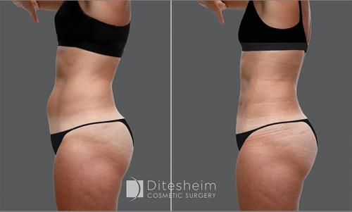 This athletic 46yr woman had a tummy "pooch" which was removed with Aquashape liposuction awake. 